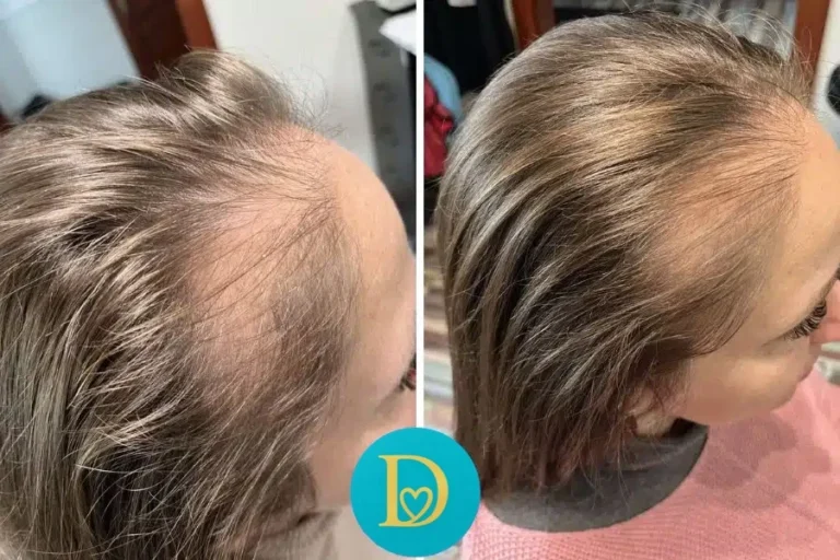 Before and after hair regrowth at the temples of a female client visible thickening and fuller hairline after 5 Dettycated oxygen scalp treatments.