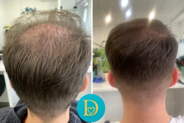 Before and after image of male hair restoration visible crown thickening and fuller coverage after Dettycated hair therapy sessions.