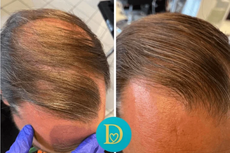Before and after of a male client’s frontal hairline restoration visible thickening and regrowth thanks to Dettycated targeted scalp treatment.