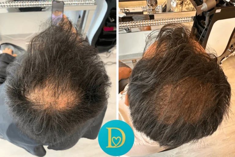 Top-down before and after of a male client with pattern hair loss noticeable density improvement after Dettycated regrowth therapy.