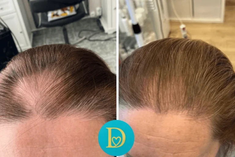 Frontal before and after of a woman’s hair regrowth journey significant improvement in hairline density and texture through Dettycated therapy.