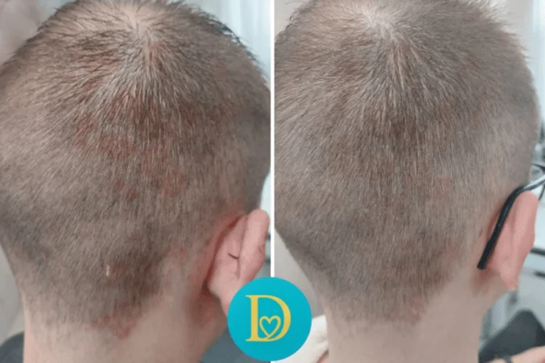 Before and after of a male scalp showing visible reduction of seborrheic irritation and redness following Dettycated treatment program.
