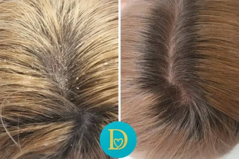 Closeup before and after of a scalp treated for dandruff and seborrhea showing a flake free and healthier scalp with Dettycated care.