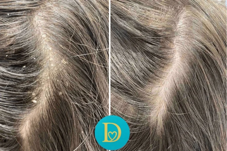Before and after closeup of a scalp with dandruff visibly reduced through Dettycated treatment showing clean healthy roots and a refreshed look.