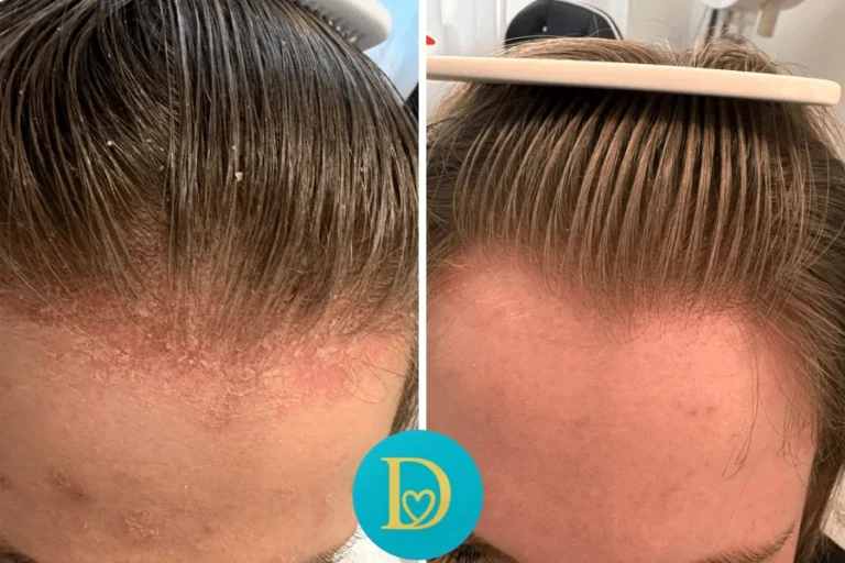 Before and after view of a forehead and hairline with psoriasis and flakes visibly reduced using Dettycated targeted scalp care leaving smooth clean skin and hair.