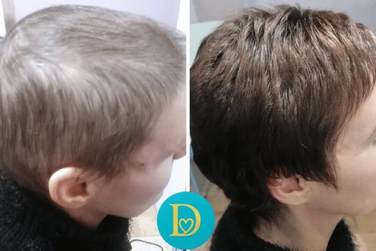 Before and after image of a female client with visibly fuller and denser hair after 10 Dettycated oxygen therapy sessions showing remarkable hair growth and texture change.