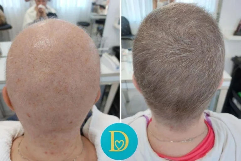 Before and after photo of a female client with full scalp hair loss showing visible regrowth and new hair coverage after 10 Dettycated oxygen therapy sessions.
